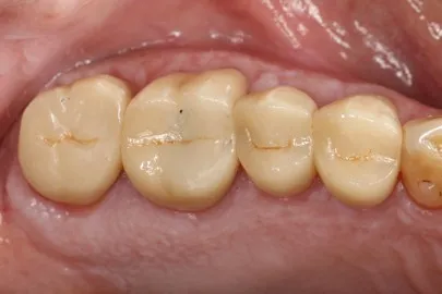 Patient back teeth after treatment - view 1