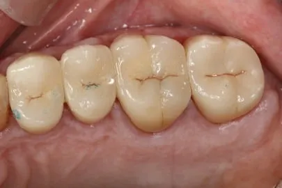 Patient back teeth after treatment - view 2