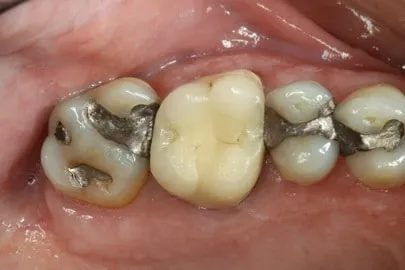 Patient back teeth before treatment - view 1