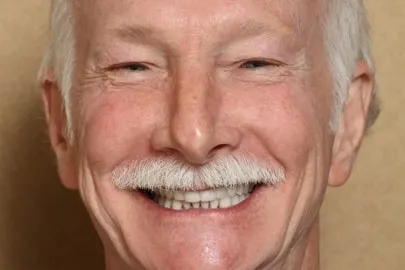 Patient face after smile restoration