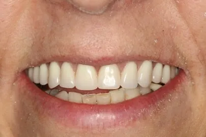 Patient teeth close-up after implants