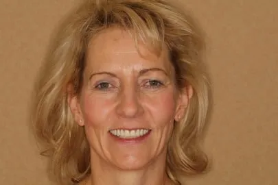 Patient face after implant treatment