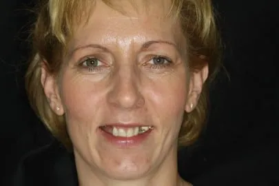 Patient face before implant treatment