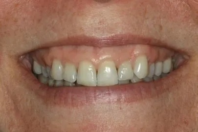 Patient teeth close-up before reconstruction