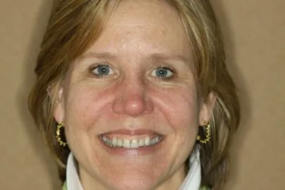 Patient face before full-mouth reconstruction