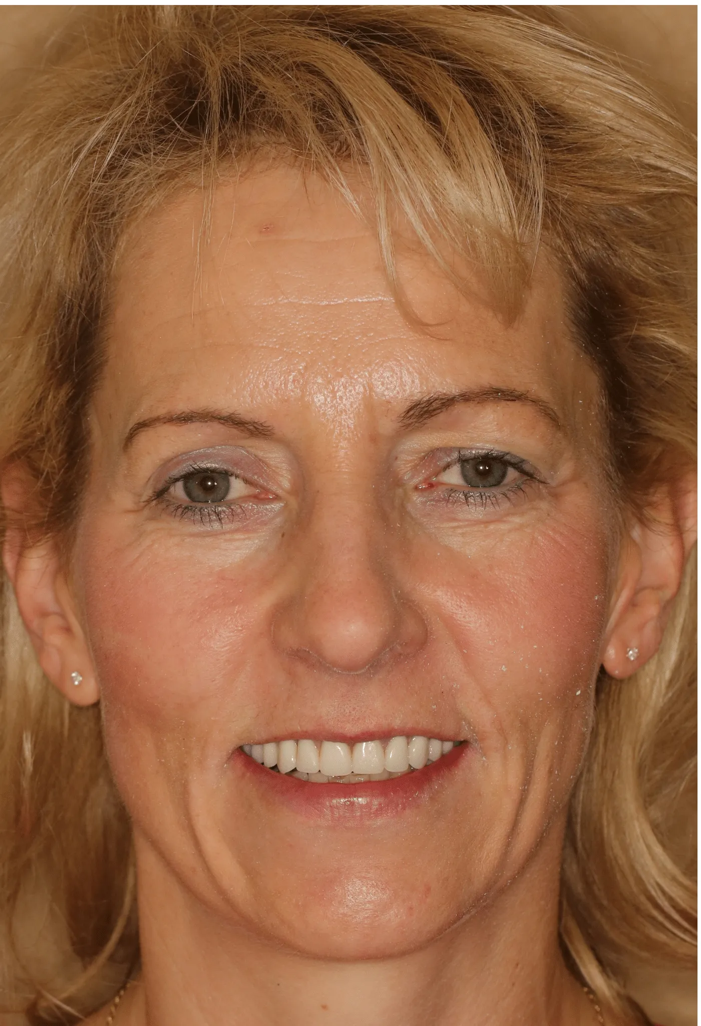 Linda's smile after treatment - close-up
