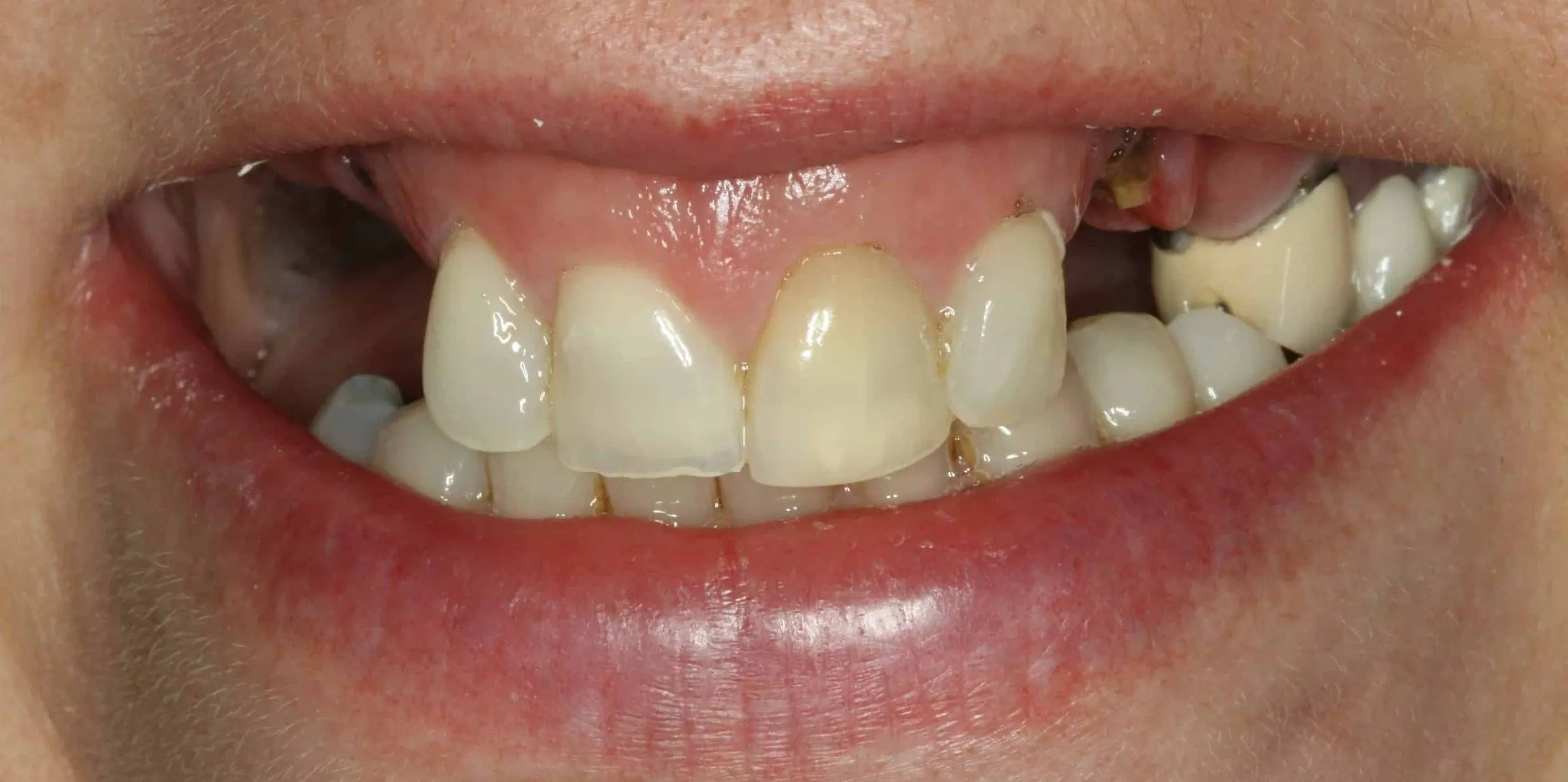 Linda's smile before treatment - portrait