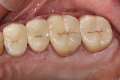 Patient back teeth after treatment - view 2
