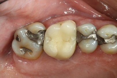 Patient back teeth before treatment - view 1