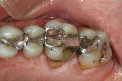 Patient back teeth before treatment - view 2