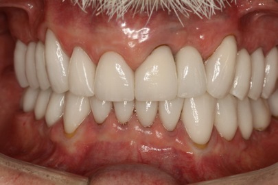 Patient teeth close-up after restoration