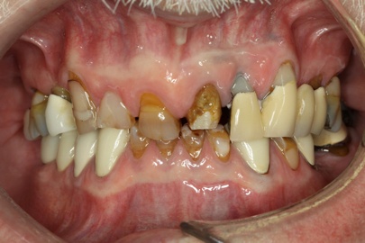 Patient teeth close-up before restoration