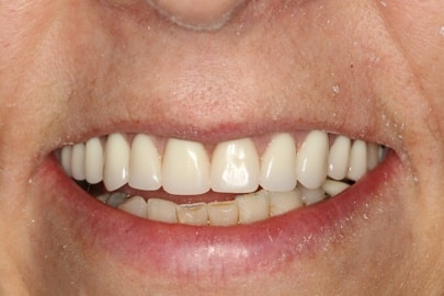 Patient teeth close-up after implants