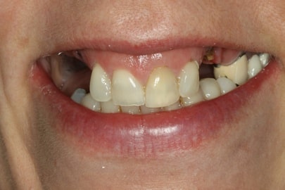 Patient teeth close-up before implants