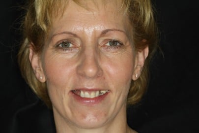 Patient face before implant treatment