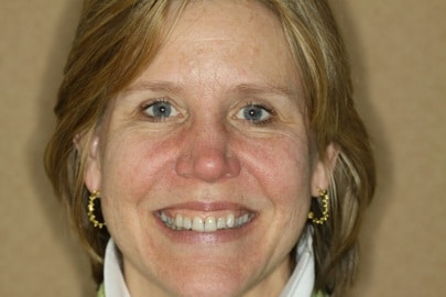 Patient face before full-mouth reconstruction