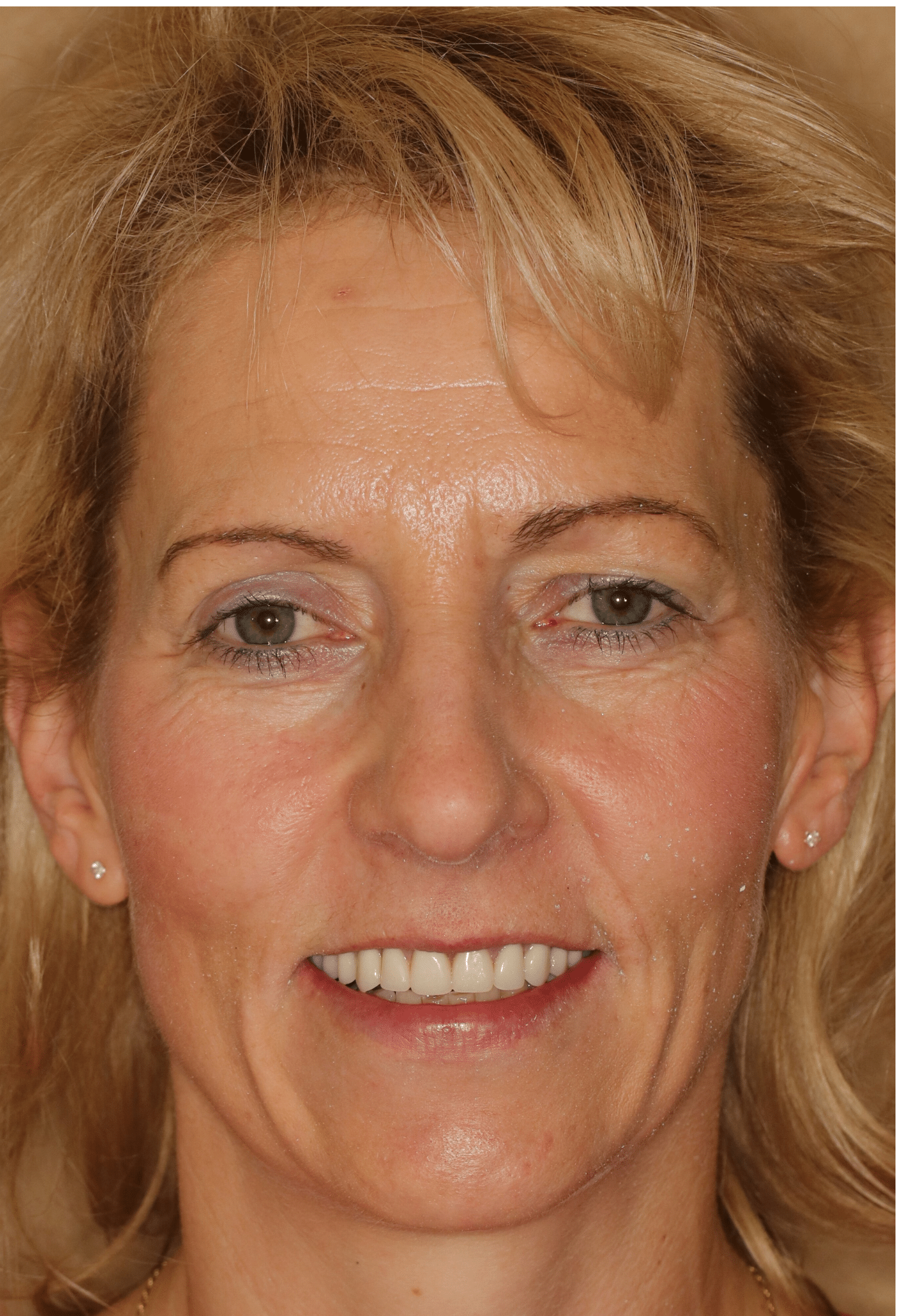 Linda's smile after treatment - close-up