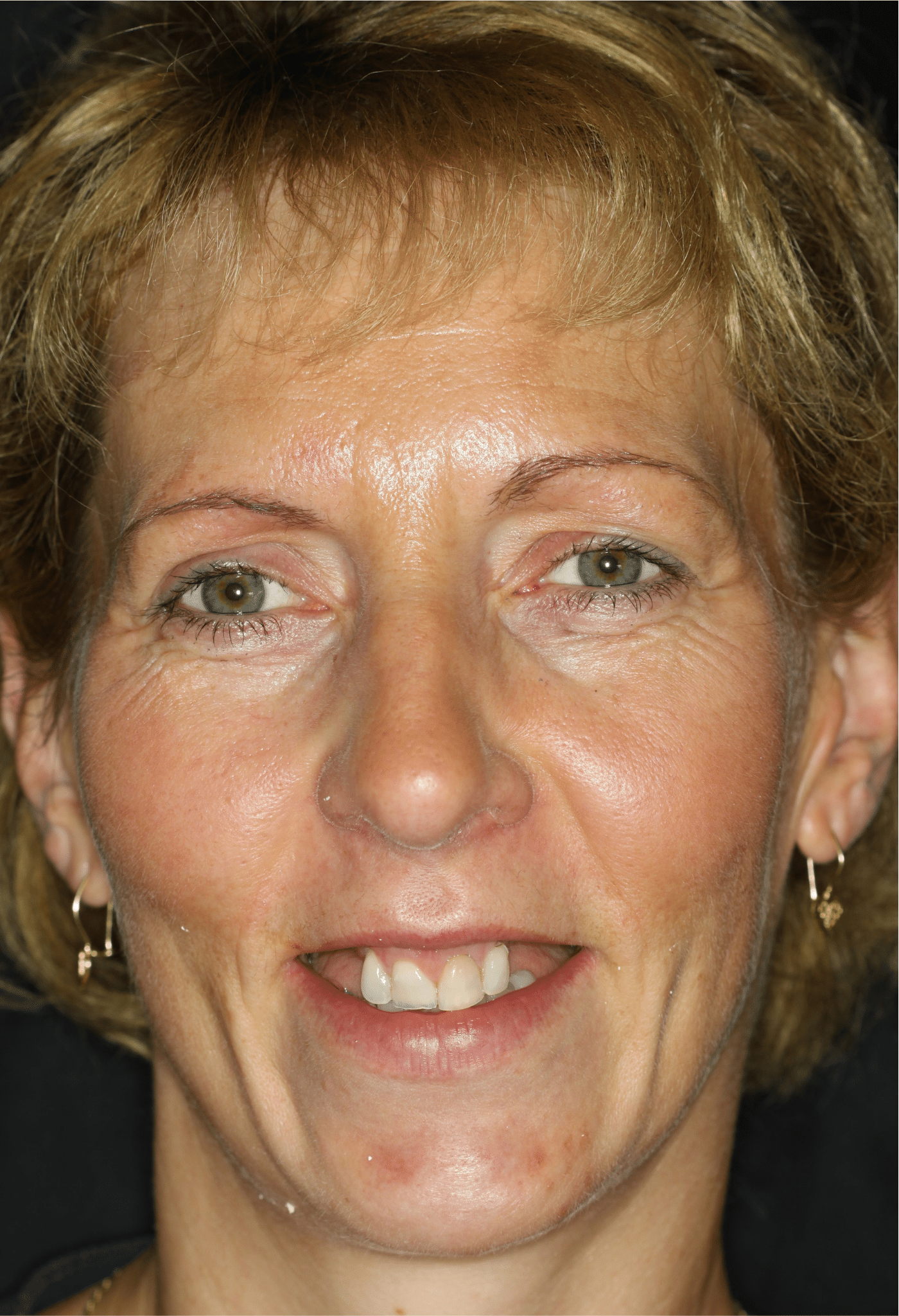Linda's smile before treatment - close-up