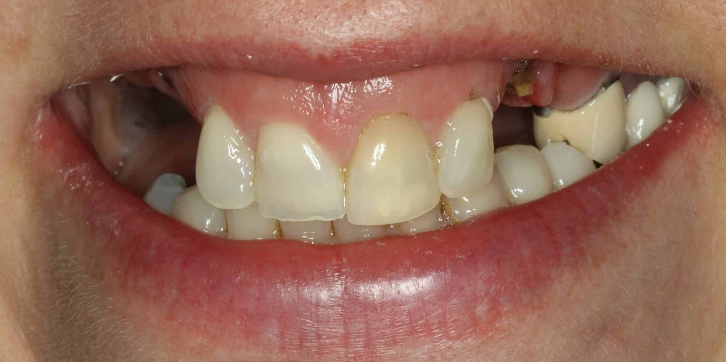 Linda's smile before treatment - portrait